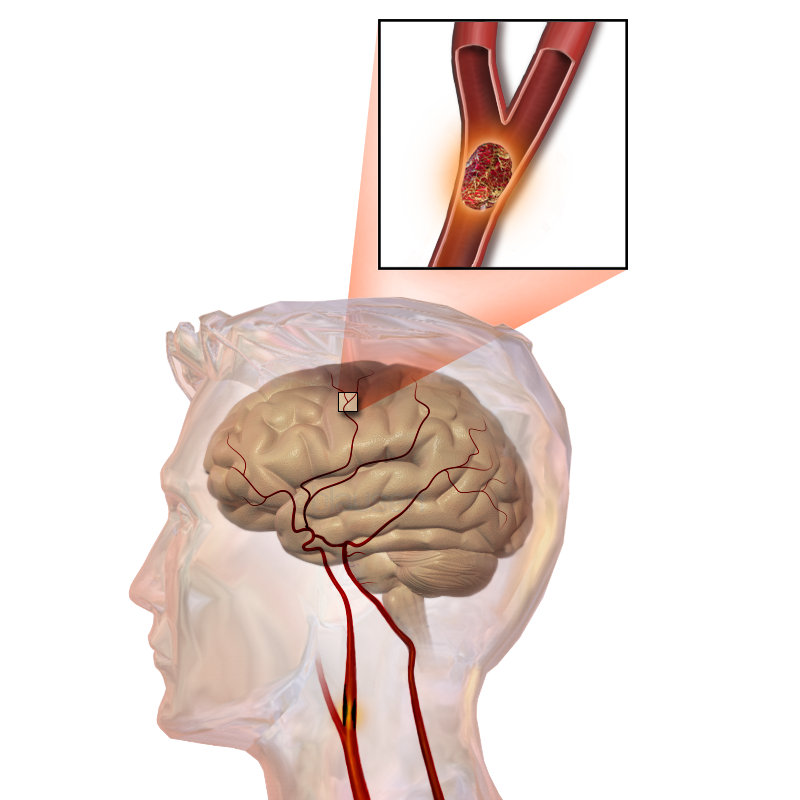 Спазм сосудов мозга. Ишемический инсульт головного мозга. Ишемический инсульт картинки. Ишемический инсульт сердца.